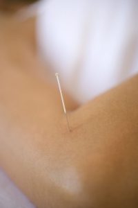 Acupuncture for tennis Elbow