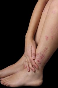 Acupuncture for Psoriasis
