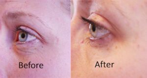 Eyes before and after facial rejuvenation.