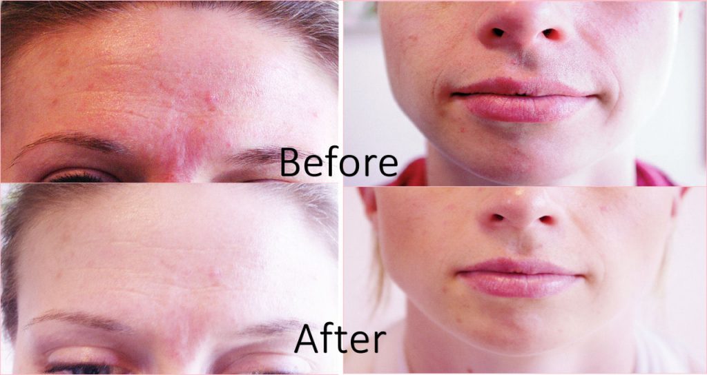 forehead-mouth_before-after-1024x544